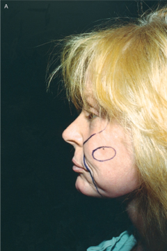 Figure 3. (a) Before the procedure is performed, it is critical to draw an oval over the area of the submalar depressions.