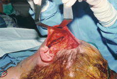 Figure 4. A fusiform is scribed during the procedure. The medial end of the SMAS fusiform should be at the center of the depressions and the lateral point at the posterior earlobe. A defect is created within the lateral portion of the fusiform, but not the medial aspect. The lateral point should be pointed to the posterior earlobe where the dog-ear effect will not be as visible. A defect is made only within the lateral aspect of the fusiform. The medial aspect of the fusiform is left alone before closure.