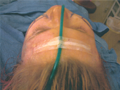 Figure7. Intraoperative shot demonstrating the right side after fusiform closure and the left side not yet operated upon. Notice the significant augmentation of the right side as compared with the left.