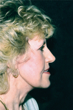 Figure 9. (b) After the technique described in this article. Note the augmentation of the cheek. The patient also had blepharoplasty.