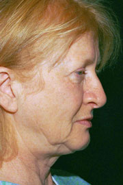 67-year-old white female five years post-op from QuickLift and upper lid blepharoplasty.