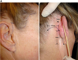 Fig.4. (A) Surgical markings are begun on the tragus and extend along the front of the ear and 3 mm behind the temporal hairline. Notice how the line meanders along the anatomy of the ear, creating a much less detectable scar. The line is extended 2 mm above the posterior earlobe crease and is 4 cm in length. The hockey stick usually is 1.5 cm to 3.5 cm in length but varies in size depending on the amount of excessive posterior neck skin available for Burrow’s triangle excision during the procedure. (B) Outline of the extent of subcutaneous undermining. The undermining should be 1 cm below the inferior border of the brow, 5 cm anterior to the tragus parallel to the floor, 5.5 cm anterior to the earlobe along the mandible, 6 cm directly inferior to the earlobe, and 2.5 to 4.0 cm away from the earlobe crease. (Courtesy of Dominic Brandy, MD, Pittsburgh, PA.)
