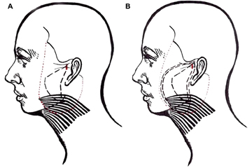 Fig.6. Illustration of the purse-string pattern. (A) After placement of the first anchor suture, a series of 1- to 1.5-cm bites of fibrous SMAS starts posteriorly and extends down toward the angle of the mandible and then back up towardtheanchorpoint.Thediameterofthisfirstpursestringis4to5cm.(B)Thesecond1.5-cmanchorsuture(indi- cated by theheavydashedlinesin theupper preauricular region)starts3 mm superiorand3 mm lateralto theknot ofthefirstanchorsuture’sknot.Fourtofive1.5-cm-longgraspsofSMASaremadeinadirectlyinferiordirection.The next four 1.5-cm-long grasps will be of platysma and should follow directly behind the edge of skin undermining. Oncethesurgeonhasreachedthesameheightasthesuperioraspectofthesecondanchorsuture,superficialgrasps aremadedirectlytowardthesecondanchorsuture.Thelastgraspoftissuebeforehittingthesecondanchorsuture will be the third anchor suture and should be 3 mm deep. The second and third anchor sutures thus will create a V-shaped anchoring point for the platysma, jowl, and midface. (Courtesy of Dominic Brandy, MD, Pittsburgh, PA.)