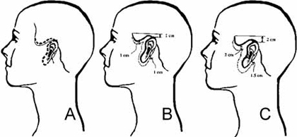Figure 2. (A)The initial incision for the QuickLift starts superiorly 3 mm behind the temporal hairline and extends to the preauricular area and ends in the posterior case of the earlobe with a 1-to-2 cm hockey-stick incision parallel to Langer lines. (B)This configuration allows for greater superior advancement of the flap with a better smoothing effect to the skin inferior and posterior to the earlobe. If removal of 1 cm of superior skin is anticipated (estimated by pushing upward on the patient's facial skin), the temporal incision should be extended 1 cm superior to the top of the ear. (C)If removal of 2 cm of superior skin is anticipated, the temporal incision should be extended 2 cm superior to the top of the ear.