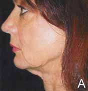 Figure 6. A 53-year-old woman before (A) the QuickLift procedure. Notice minimal swelling and postoperative bruising.