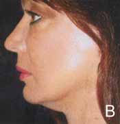 Figure 6. A 53-year-old woman 1 day after (B) the QuickLift procedure. Notice minimal swelling and postoperative bruising.
