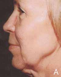 Figure 7. A 56-year-old woman before (A) the QuickLift procedure. Stability of the initial effect was observed.